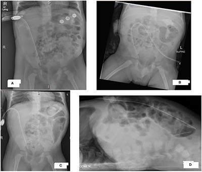 Case Report: Recurring Peritonitis and Dialysis Failure in a Toddler on Peritoneal Dialysis